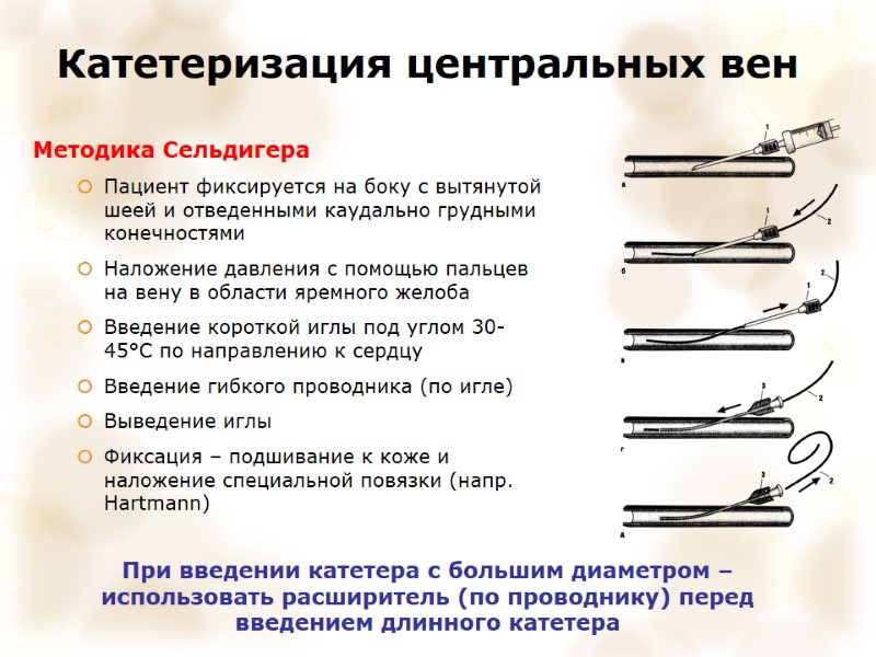 Катетеризация центральных вен Методика Сельдигера Пациент фиксируется на боку с вытянутой шеей и отведенными